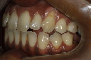 15036189 1367122209974099 5535259369043926429 n 300x200 - Dentes sensíveis