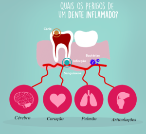 dor de dente 300x276 - Dor de Dente