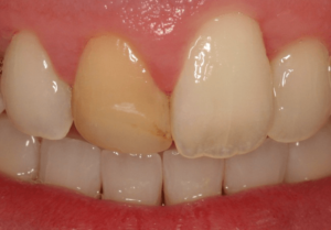 veneers 300x209 - Dor de Dente