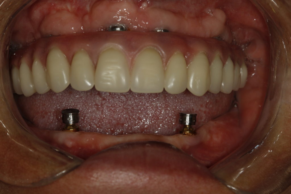 MG 5475 1024x683 - Overdenture