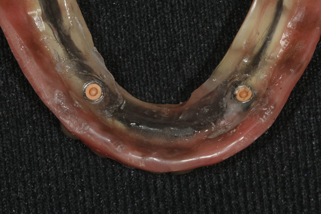 MG 5491 1024x683 - Overdenture