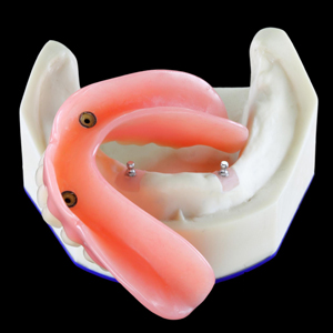 Overdenture oring - Overdenture